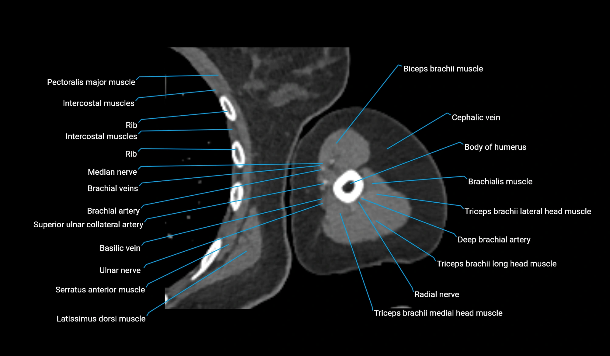 CT upper arm axial  cross sectional anatomy labelled radiology image -00238.webp